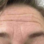Botox Before & After Patient #540