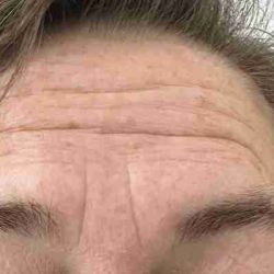 Botox Before & After Patient #540