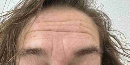 Botox Before & After Patient #540