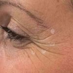 Botox Before & After Patient #543
