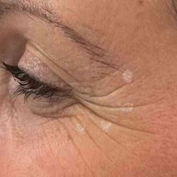 Botox Before & After Patient #543