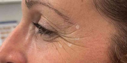 Botox Before & After Patient #543