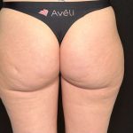 Aveli Before & After Patient #507