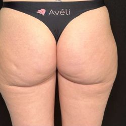 Aveli Before & After Patient #507