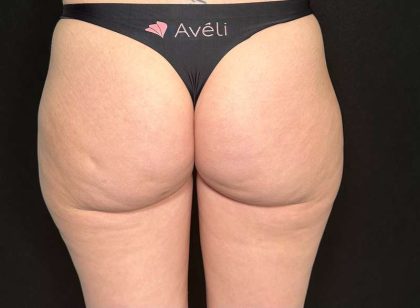 Aveli Before & After Patient #507