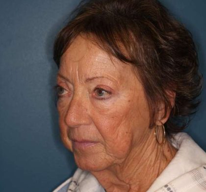Facelift Before & After Patient #596