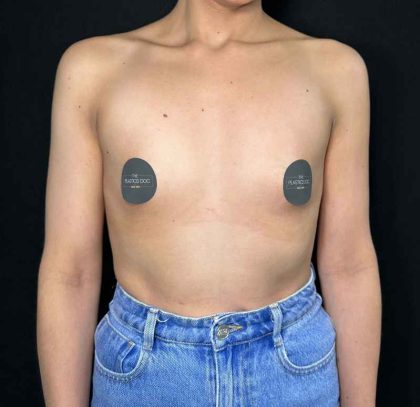 Breast Augmentation Before & After Patient #647