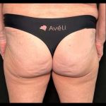 Aveli Before & After Patient #516