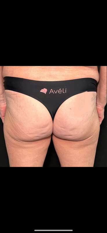 Aveli Before & After Patient #516