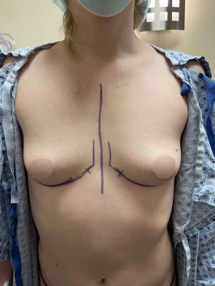 Breast Augmentation Before & After Patient #709