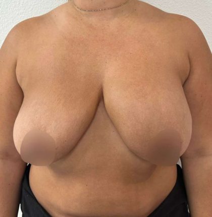 Breast Lift Before & After Patient #724