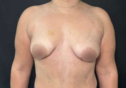 Breast Lift Before & After Patient #733