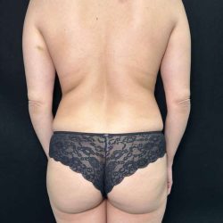 Liposuction Before & After Patient #764