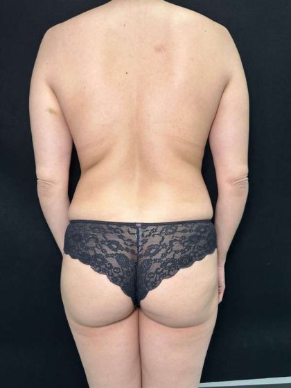 Liposuction Before & After Patient #764