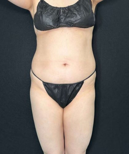 Liposuction Before & After Patient #770