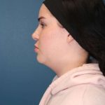 Chin Lipo Before & After Patient #773