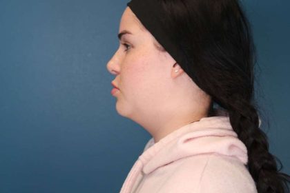 Chin Lipo Before & After Patient #773