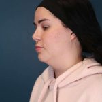 Chin Lipo Before & After Patient #773