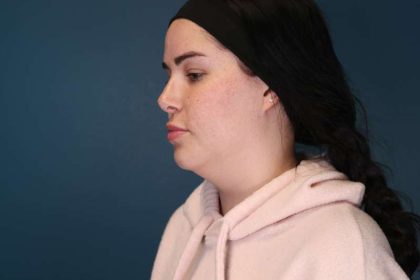 Chin Lipo Before & After Patient #773