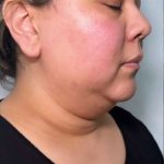 Chin Lipo Before & After Patient #779
