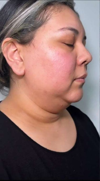 Chin Lipo Before & After Patient #779