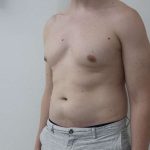 Liposuction Before & After Patient #838