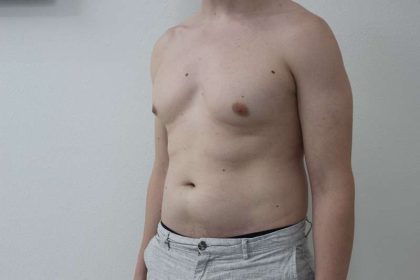 Liposuction Before & After Patient #838
