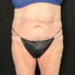 Tummy Tuck Before & After Patient #880