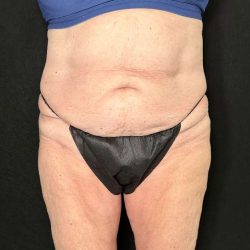 Tummy Tuck Before & After Patient #880