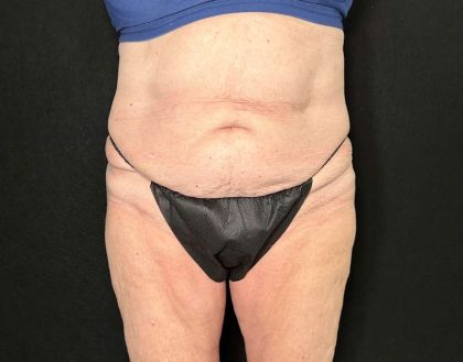 Tummy Tuck Before & After Patient #880