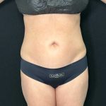 Tummy Tuck Before & After Patient #886