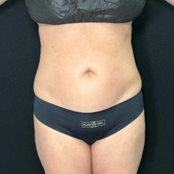 Tummy Tuck Before & After Patient #886