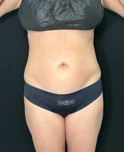 Tummy Tuck Before & After Patient #886