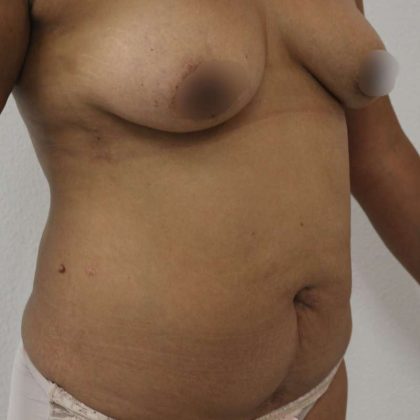 Tummy Tuck Before & After Patient #912