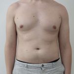 Liposuction Before & After Patient #838