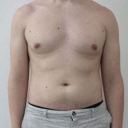 Liposuction Before & After Patient #838