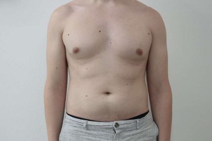 Liposuction Before & After Patient #838
