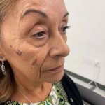 Botox Before & After Patient #552