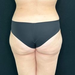 Brazilian Butt Lift Before & After Patient #557