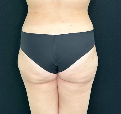 Brazilian Butt Lift Before & After Patient #557