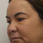 Eyelid Lift Before & After Patient #632