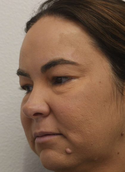 Eyelid Lift Before & After Patient #632