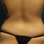 Liposuction Before & After Patient #792