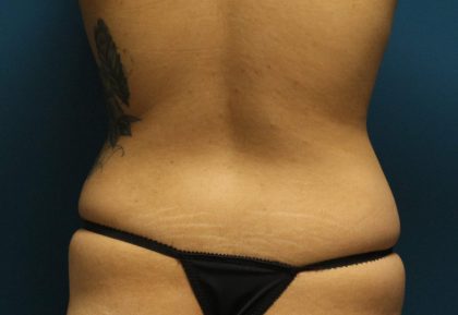 Liposuction Before & After Patient #792