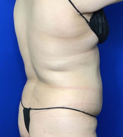 Liposuction Before & After Patient #809