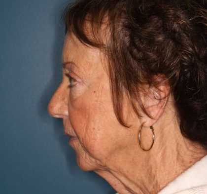 Facelift Before & After Patient #596