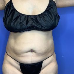 Liposuction Before & After Patient #849