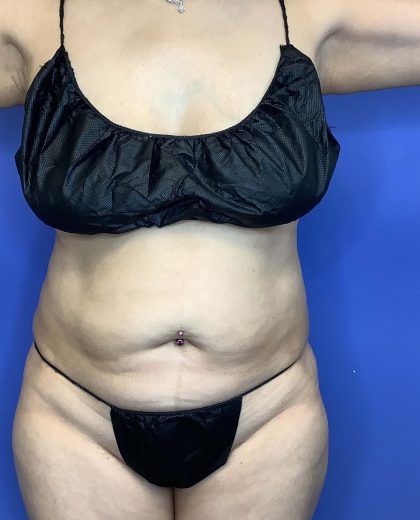 Liposuction Before & After Patient #849