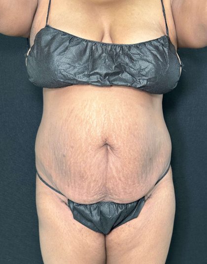 Tummy Tuck Before & After Patient #891