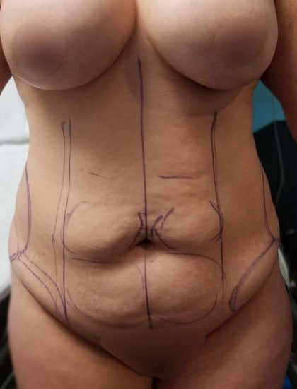 Tummy Tuck Before & After Patient #923